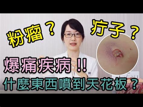 身體釘子|「長釘子」別亂擠！疔瘡是什麼？會自己好嗎？原因及治療方法一。